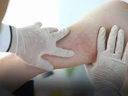 Allergy & Immunology - Physician/Faculty - Department of Pulmonary, Allergy and Critical Care Medici