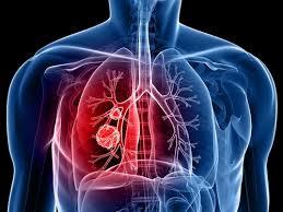 Hematology/Oncology: Thoracic Oncology, Weill Cornell Medicine, Queens