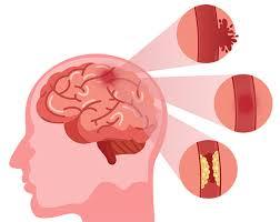 Epileptologist Torrington, Connecticut